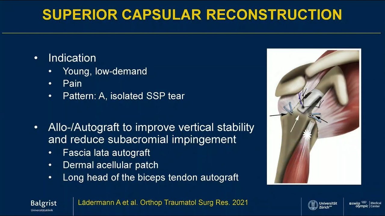 Balgrist erkl&auml;rt: Irreparable Rotatorenmanschettenruptur | Irreparable Rotator Cuff Tear
