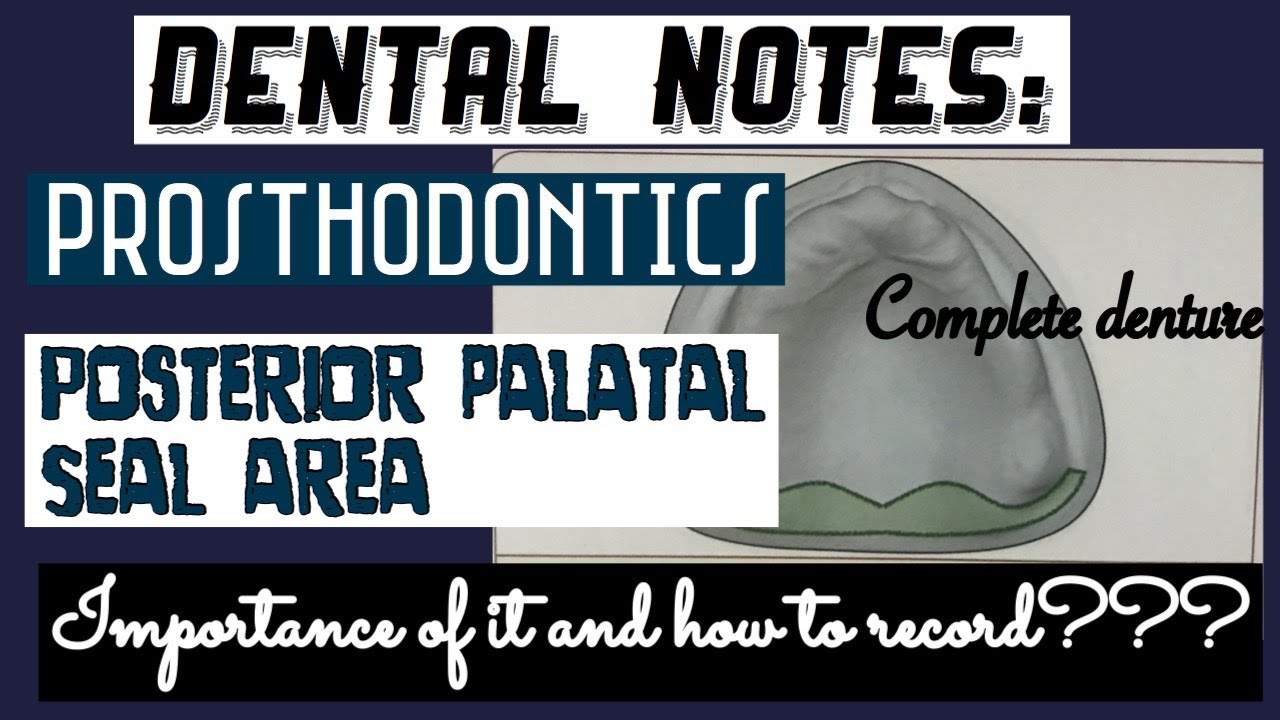 POSTERIOR PALATAL SEAL AREA (POSTDAM) II COMPLETE DENTURE II PROSTHODONTICS II DENTAL NOTES II PPS