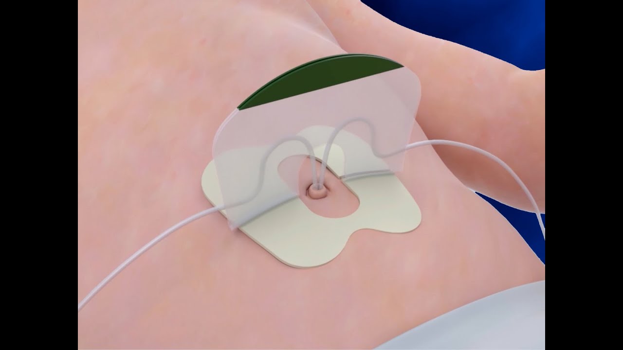 NEOBRIDGE Sujeccion para cateter umbilical - Instrucciones de uso