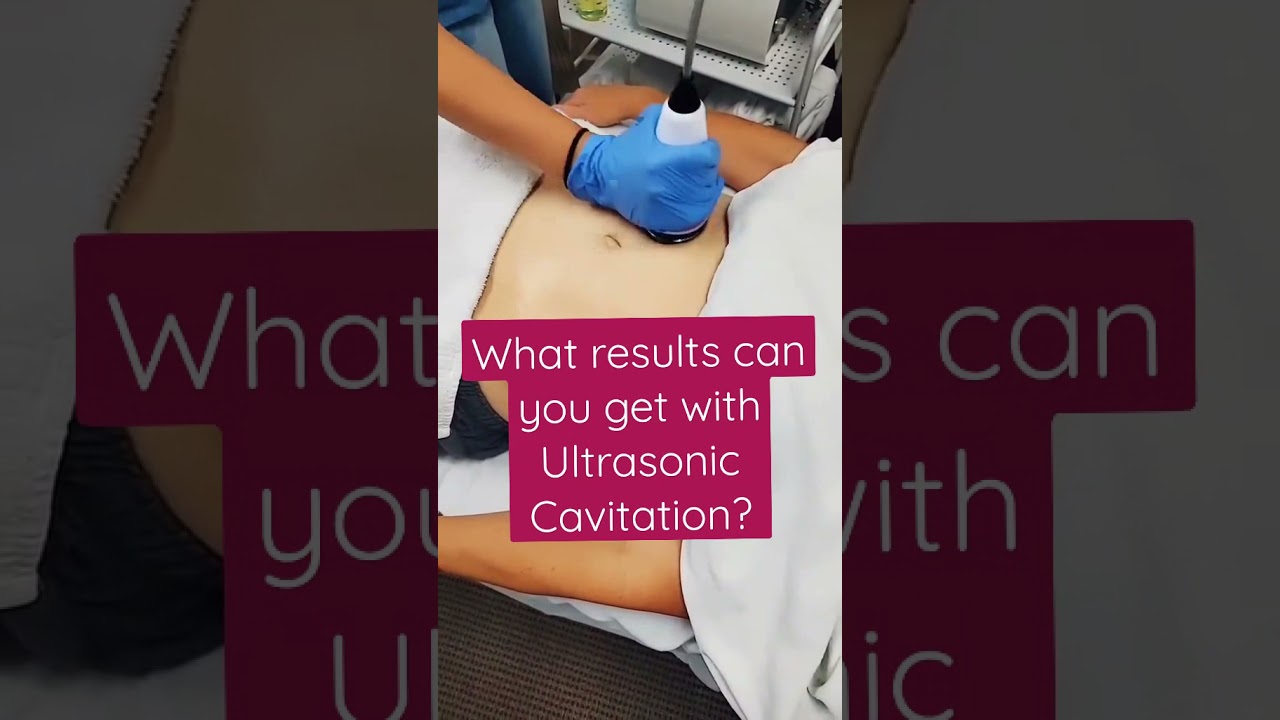 Ultrasonic Cavitation - Before and After - Murrieta, CA