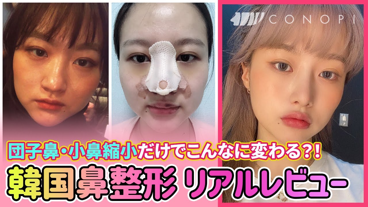 韓国鼻整形 VLOG💗ビーザニュー 【団子鼻・小鼻縮小編】