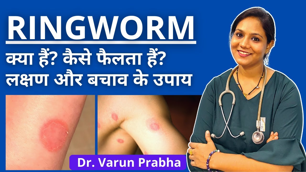Symptoms of Ringworm | Ringworm क्या होता हैं? कैसे फैलता हैं? कैसे बचें?