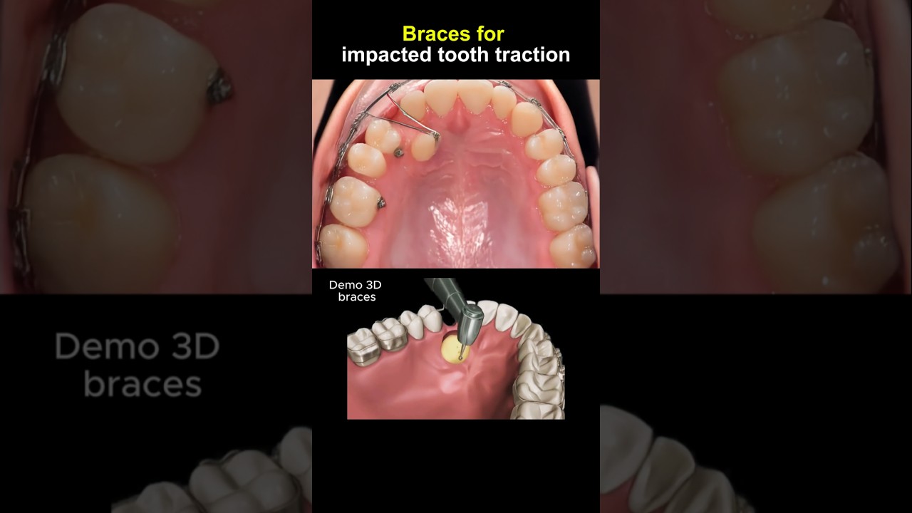 Braces pull impacted tooth #braces #dentist #orthodontist