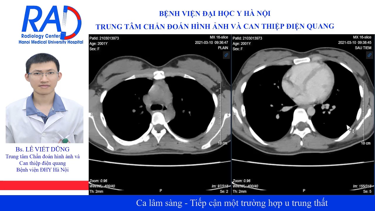 U trung thất - Tiếp cận một trường hợp được điều trị thành công tại BV Đại học Y Hà Nội