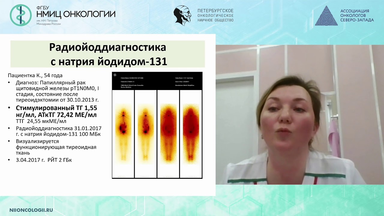 Роль радиойодтерапии в лечении рака щитовидной железы