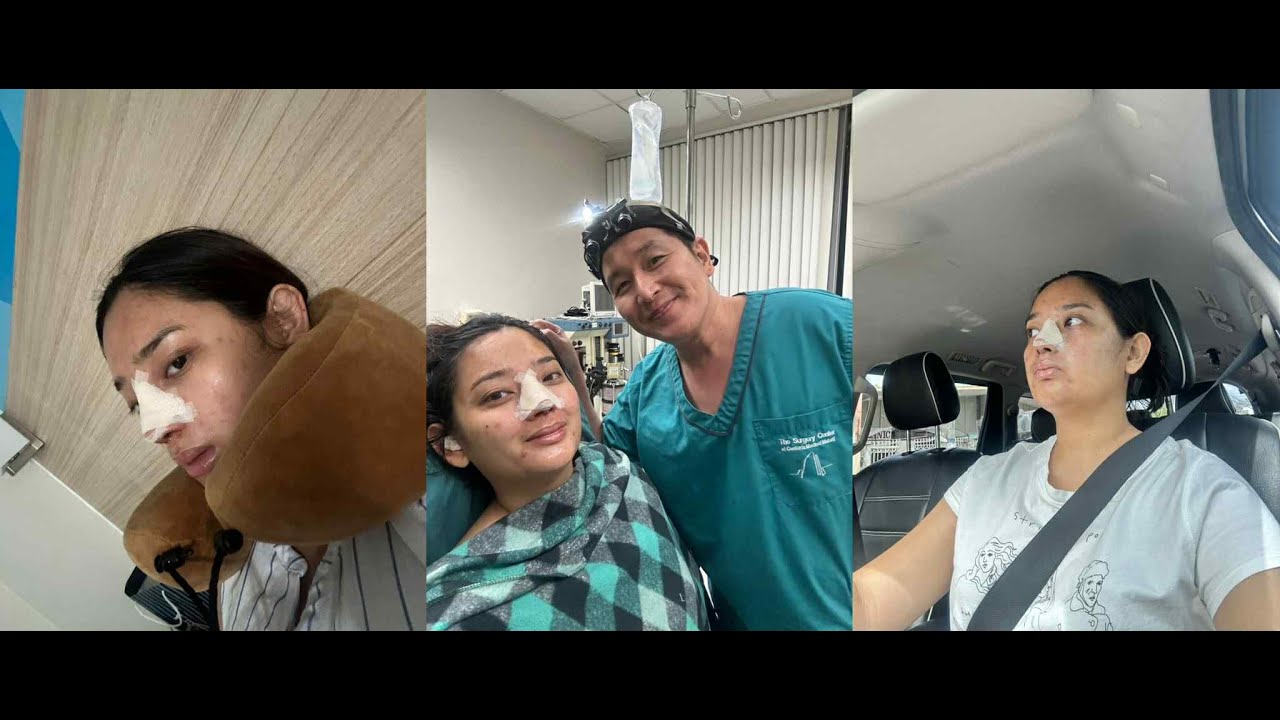 My Rhinoplasty Journey | Doc Nato baby 