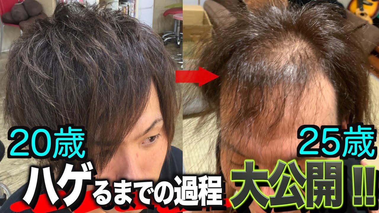 【おでこ、生え際】いつハゲたのか？過去の写真で振り返ってみた