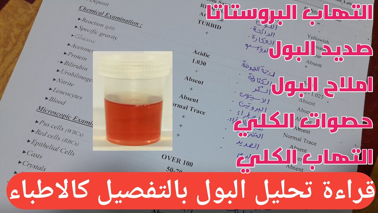قراءة تحليل البول | متى تكون النتيجة خطيرة؟ ومتى تكون طبيعية؟
