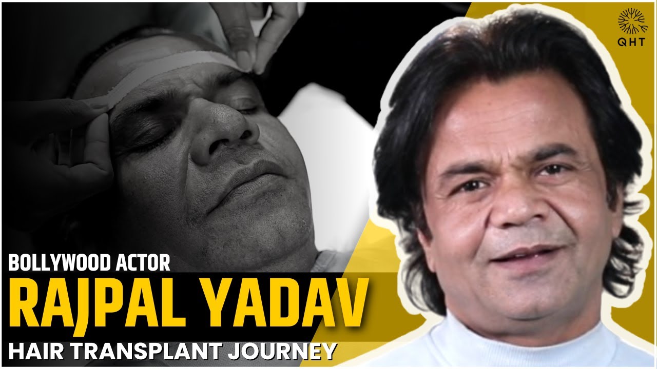 Actor Rajpal Yadav Shares His Hair Transplant Result Experience