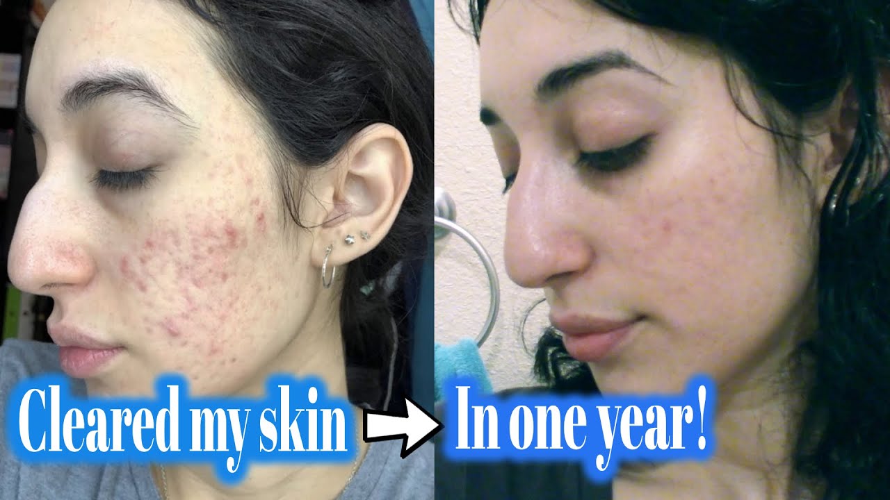 My Skin Care Routine 2020 | Acne-prone skin | Minimalist