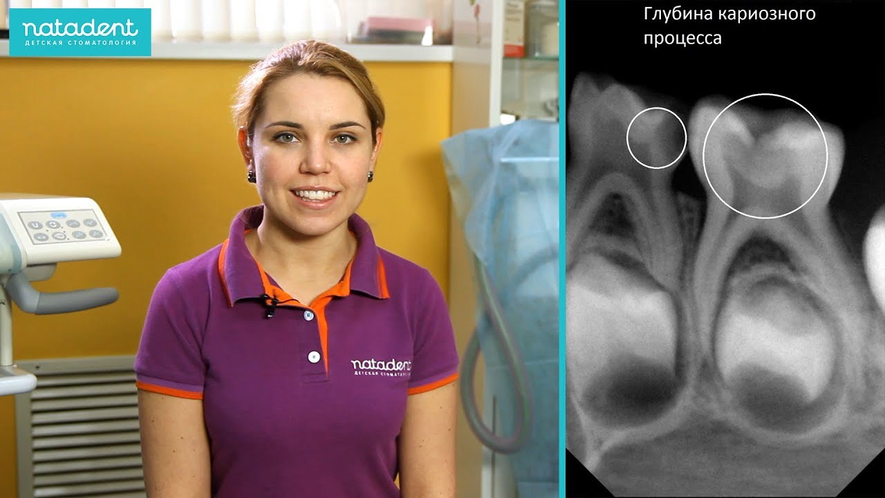 77. Когда и зачем делать рентген зубов у детей? Натадент
