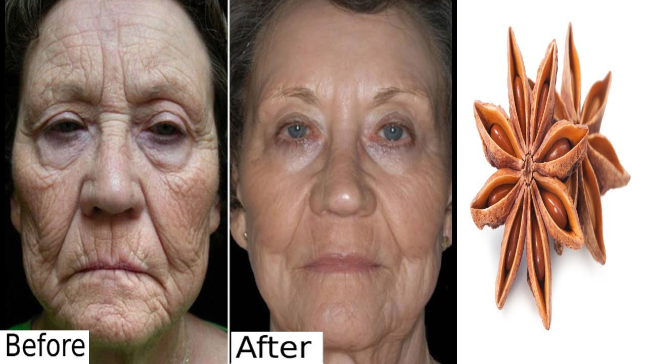 &Icirc;ndepărtarea ridurilor, lifting facial instantaneu natural, botox de casă