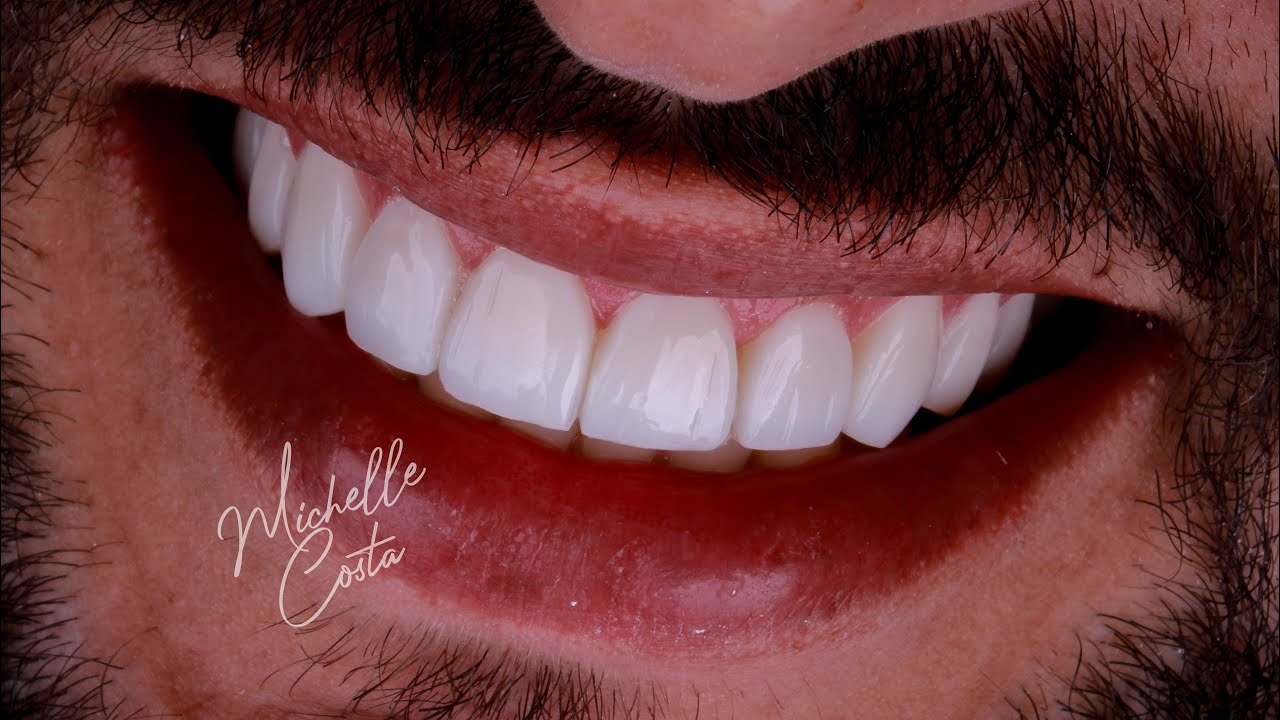 Transformações  com Lentes em Resina em Barra da Tijuca e Madureira, RJ - Mentoria para Dentistas