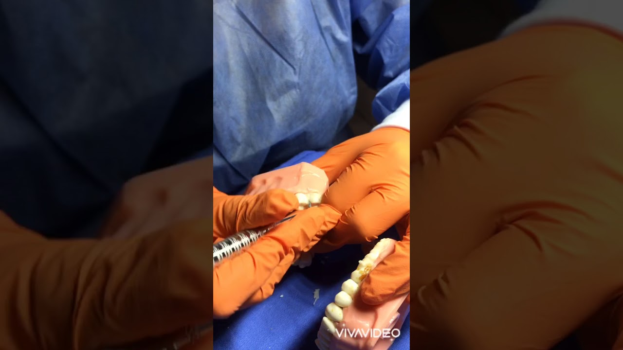 Pr&aacute;ctica figurada de eliminaci&oacute;n de c&aacute;lculo dental part.2