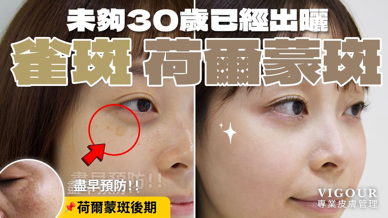 💬 真實客人大讚｜💠 VIGOUR Spot KILLER｜專治荷爾蒙斑＋雀斑