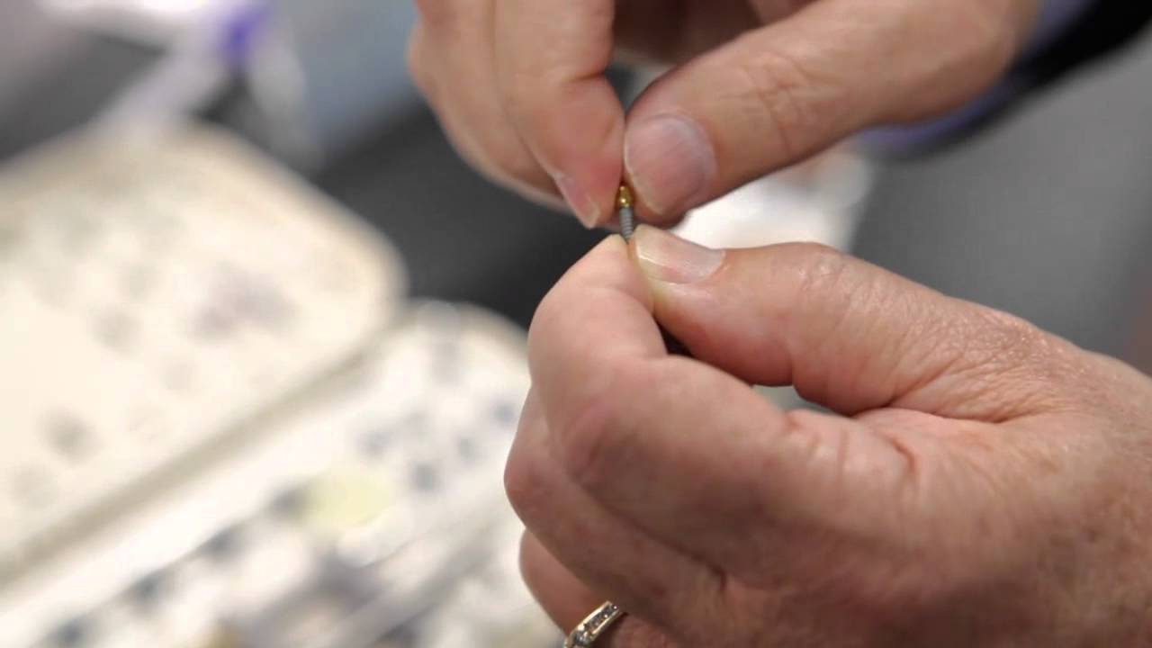 Zest Anchors on LOCATOR Overdenture Implant