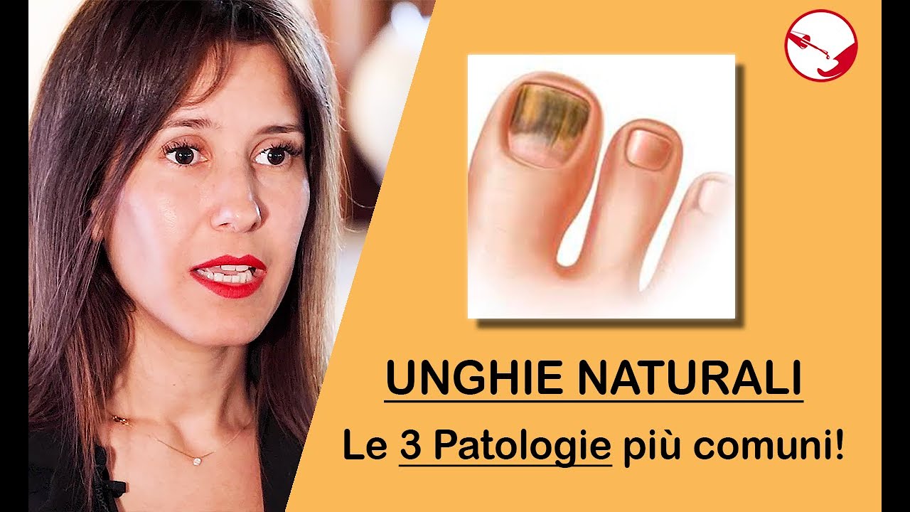 3 di 5 - PATOLOGIE UNGHIE | Onicolisi, Onicomicosi & Infezione batterica (3 patologie pi&ugrave; comuni)