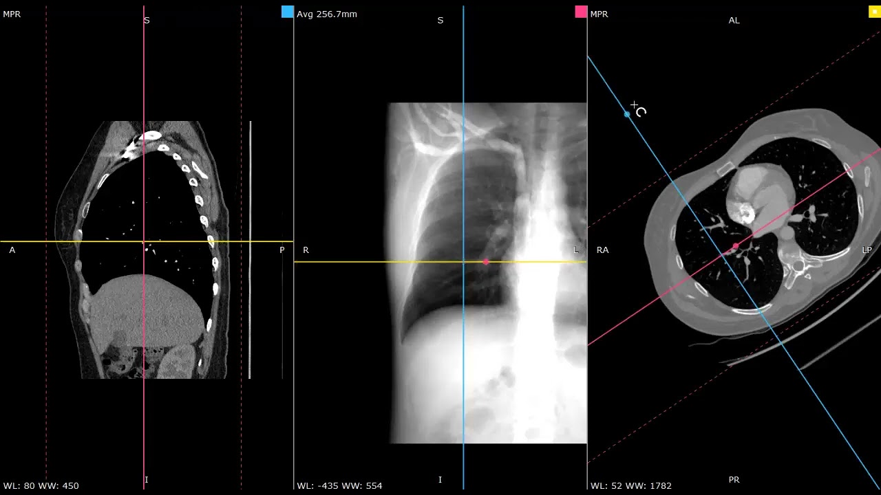 Proyecciones para Costillas. Técnicas radiológicas Primer año.