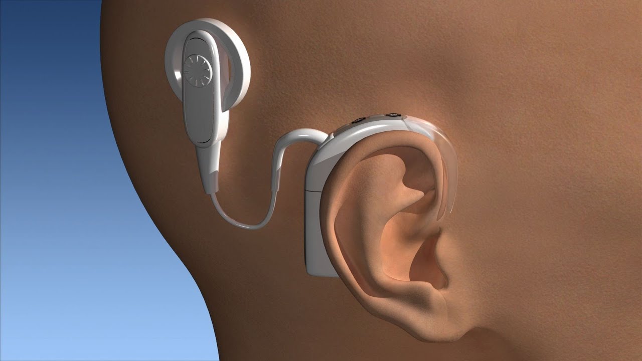 Beyond a Hearing Aid - Mayo Clinic