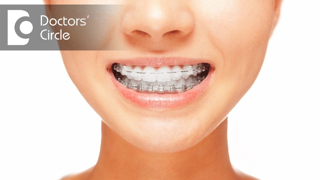 Do braces hurt? - Dr. Rajeev Kumar G