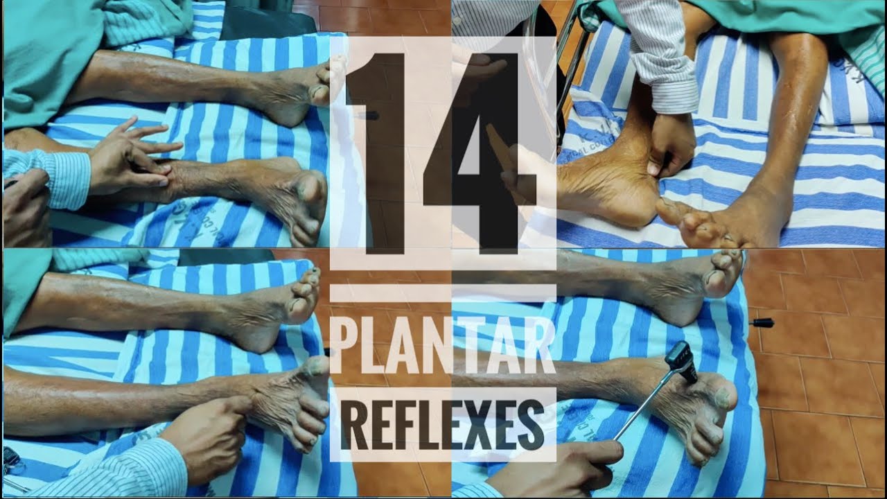 14 Abnormal plantar reflexes (Babinski equivalents)