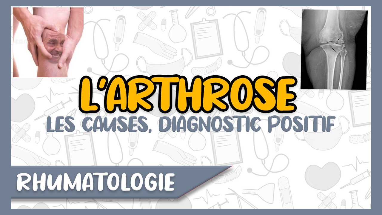 Comprendre Facilement L' Arthrose | Facteurs de Risque, Diagnostic Positif, Causes | Rhumatologie