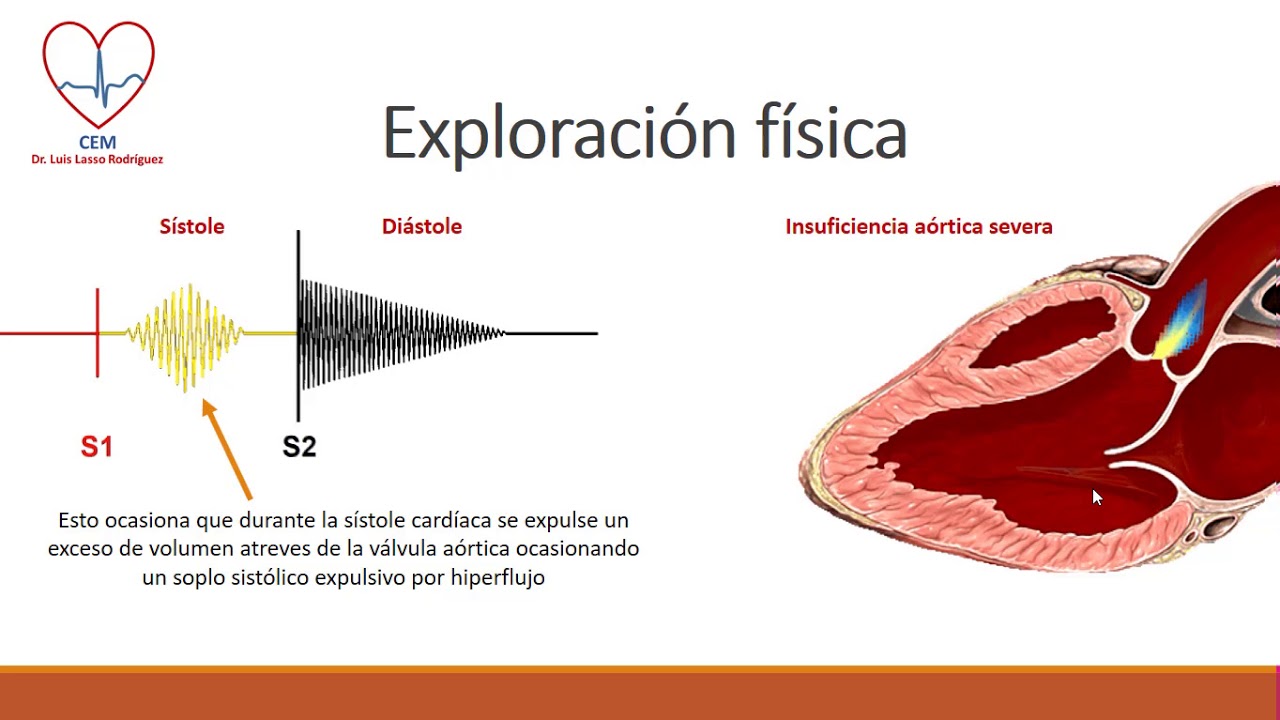 Insuficiencia aórtica
