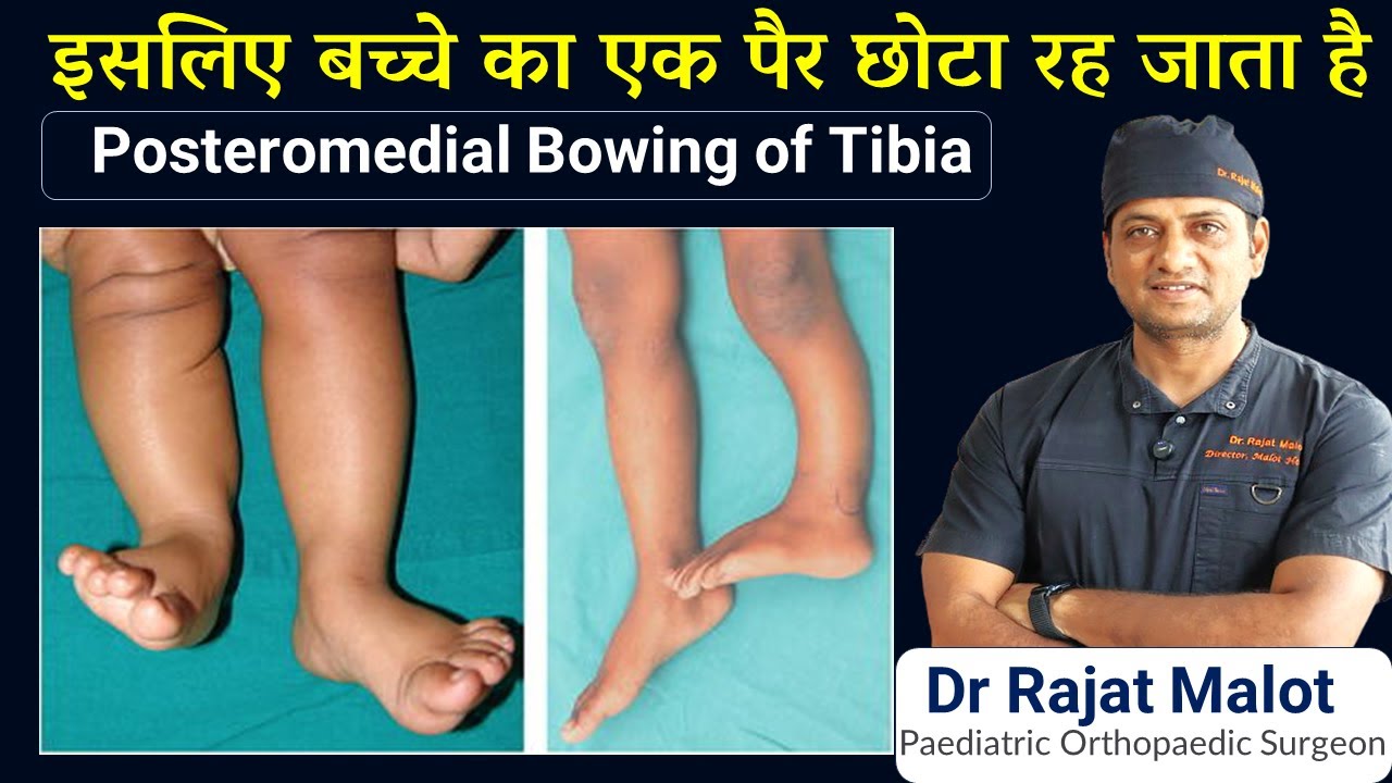Posteromedial Bowing of Tibia: Symptoms, Correction, Treatment & Leg Length Fix Dr Rajat Malot