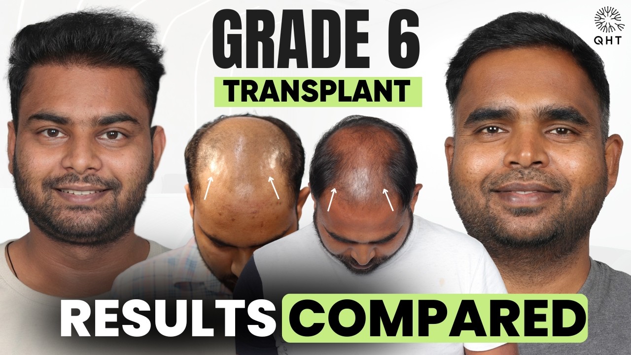Grade 6 Hair Transplant | Hair Transplant Result | Grade 6 Hair Transplant Case Study | QHT Clinic