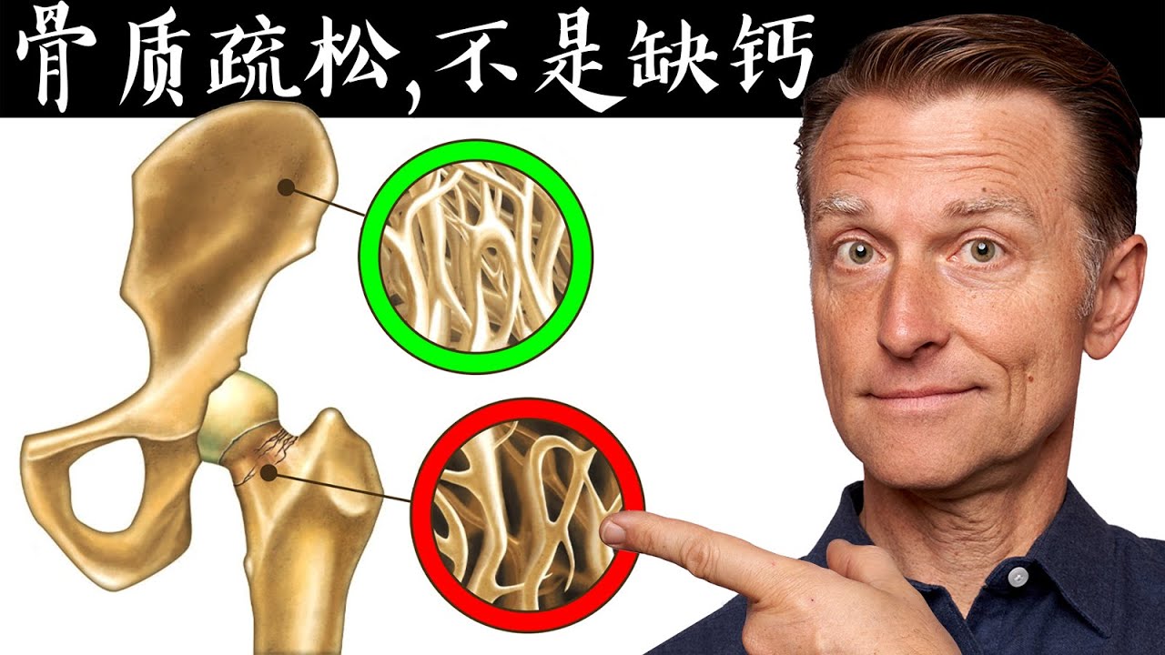 骨質疏鬆,不是缺鈣, 缺鈣症狀與原因,自然療法,柏格醫生 Dr Berg
