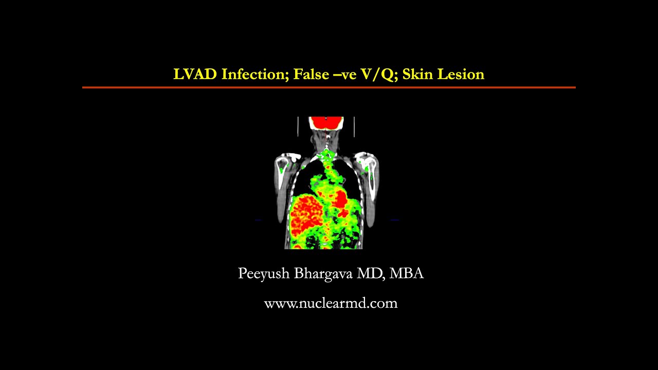 LVAD Infection; False -ve VQ; Skin Lesion