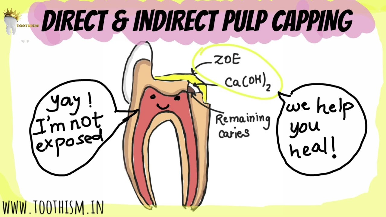 DIRECT AND INDIRECT PULP CAPPING | Vital pulp therapy | Pediatric Dentistry