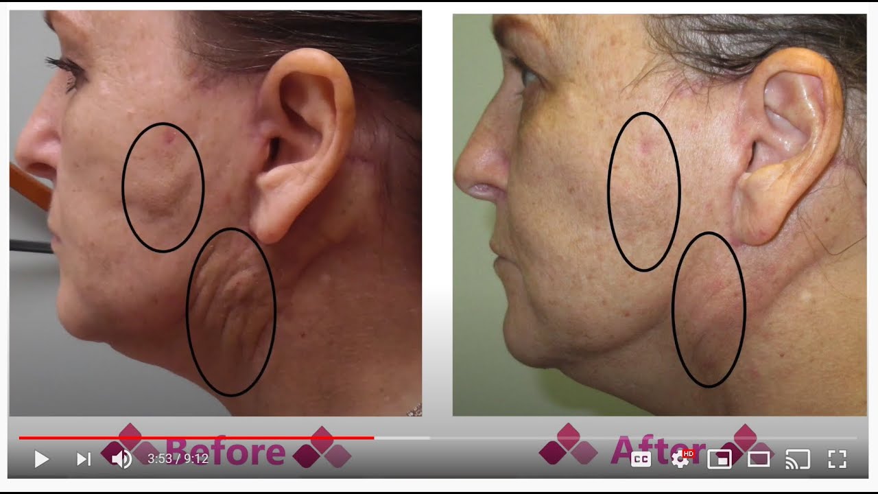 Fibrosis to Face After a Face Lift : Aspen Facelift Treatment for Lumpy Knots