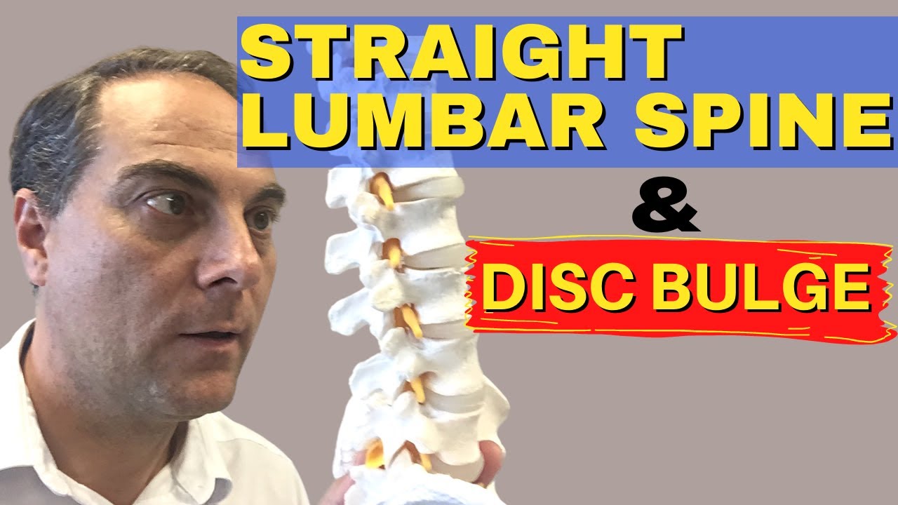 Straigthening of Lumbar Spine with L4 L5 Disc Bulge, L5 S1 Disc Bulge | Dr. Walter Salubro
