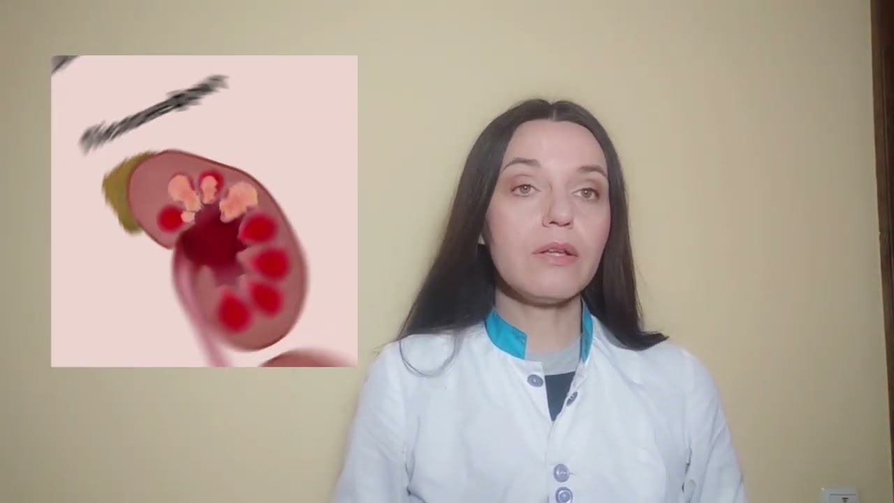 Якими ранніми ознаками характеризується хронічна ниркова недостатність.