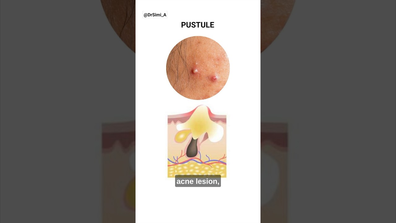 Acne Pimple Pus: How to Get Rid of It | #acne #shorts