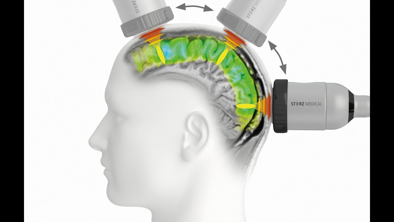 TPS® Therapy – advanced non-invasive brain stimulation