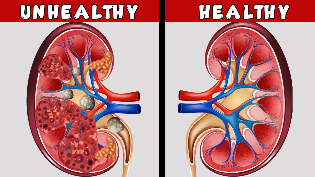 5 Way To Detox and Cleans Your Kidneys Naturally