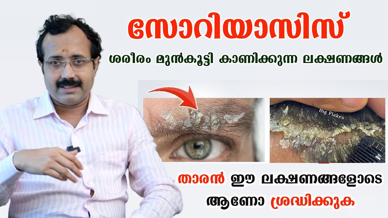 സോറിയാസിസ് ശരീരം മുൻകൂട്ടി കാണിക്കുന്ന ലക്ഷണങ്ങൾ.പൂർണ്ണമായുംമാറും ഇങ്ങനെചെയ്താൽ/Dr Padmanabha Shenoy