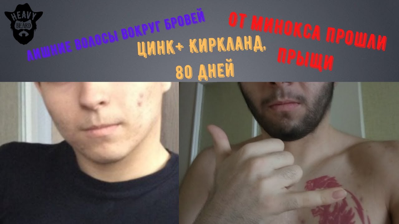 Результат в 19 лет, миноксидил 5% + цинк, улучшилась кожа!