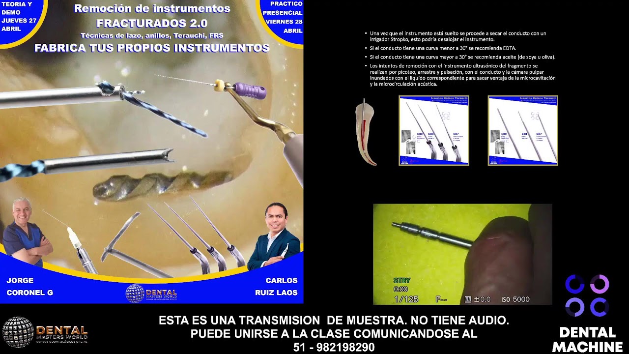 REMOCION DE INSTRUMENTOS FRACTURADOS 2.0
