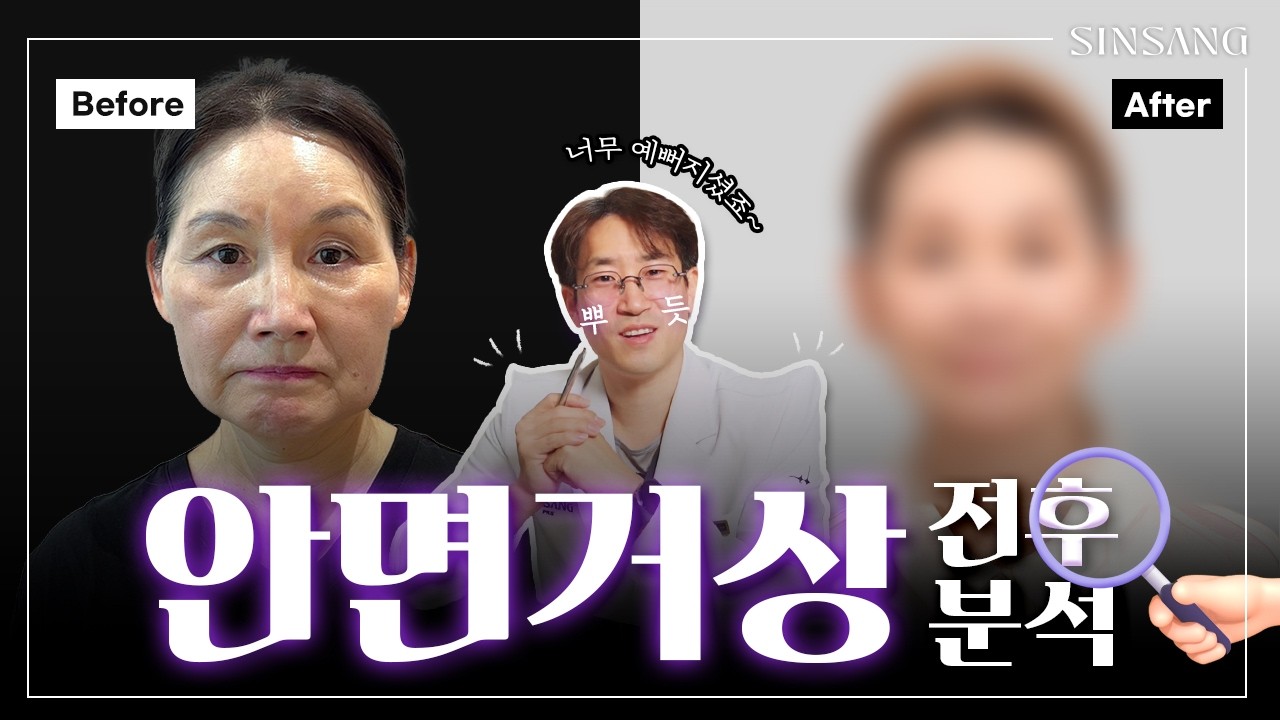 60대 안면거상 리얼 후기 | 수술 후 6개월 경과 분석
