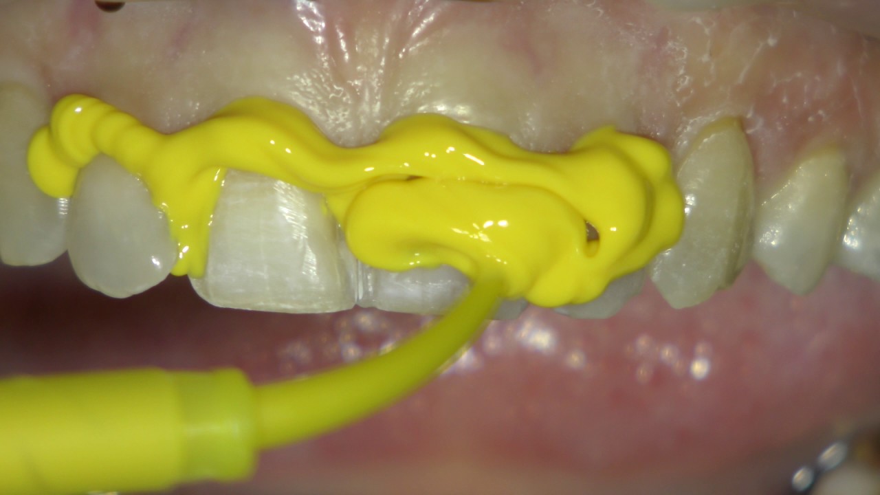 Préparation Facette et Provisoire par Injection