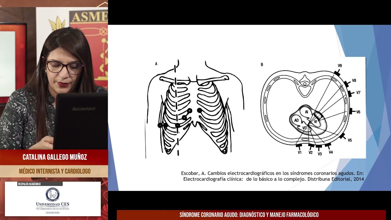Síndrome Coronario Agudo  Diagnóstico y manejo farmacológico - Catalina Gallego Muñoz