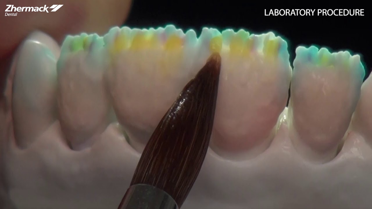 Veneers Procedure Overview Laboratory Procedure step2
