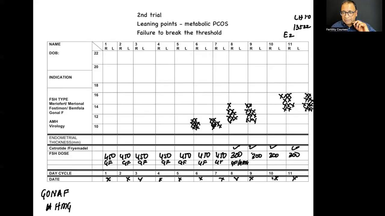 Resistant PCOS : why stimulation fails sometimes and what can you do
