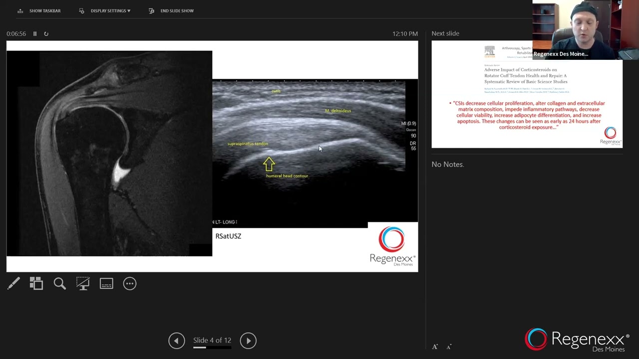 Avoid Shoulder Surgery | Webinar Replay May 25, 2022 | Regenexx Des Moines