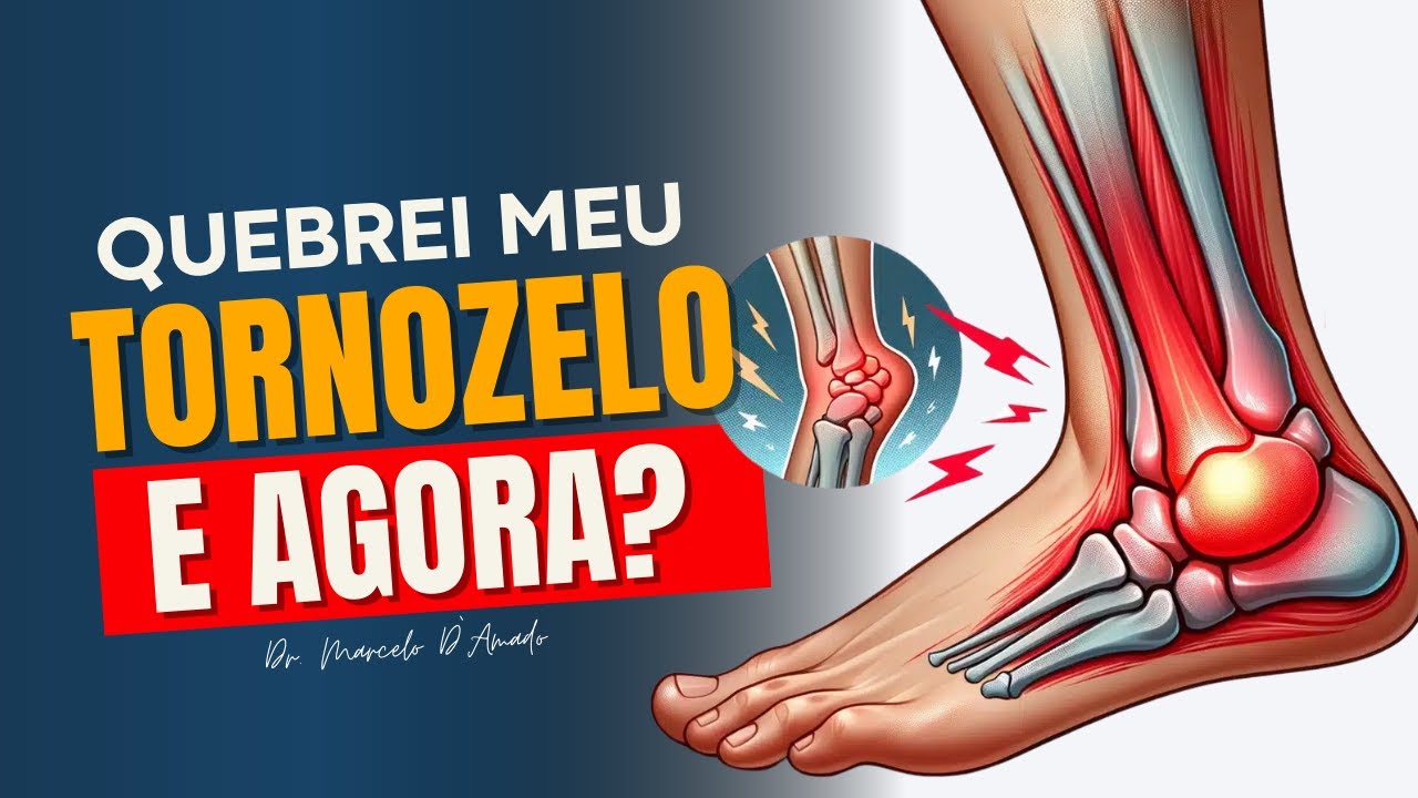 QUEBREI O TORNOZELO E AGORA? QUAIS SÃO OS PRÓXIMOS PASSOS?