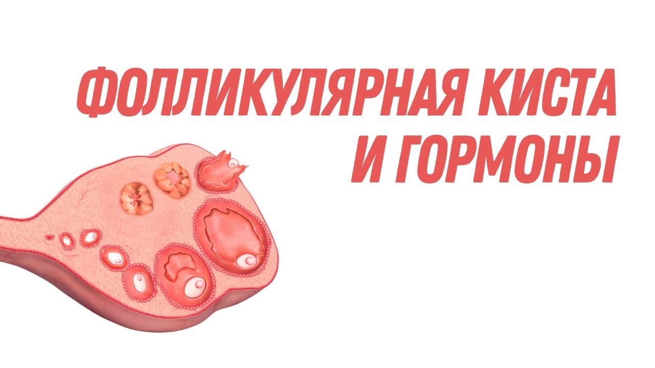 Фолликулярная киста и гормоны @DrOlenaB