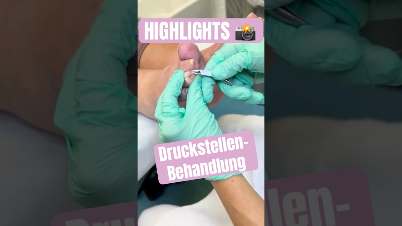 👣 Effektive Druckstellen-Behandlung | Highlights | Einfach rund um den Fu&szlig;